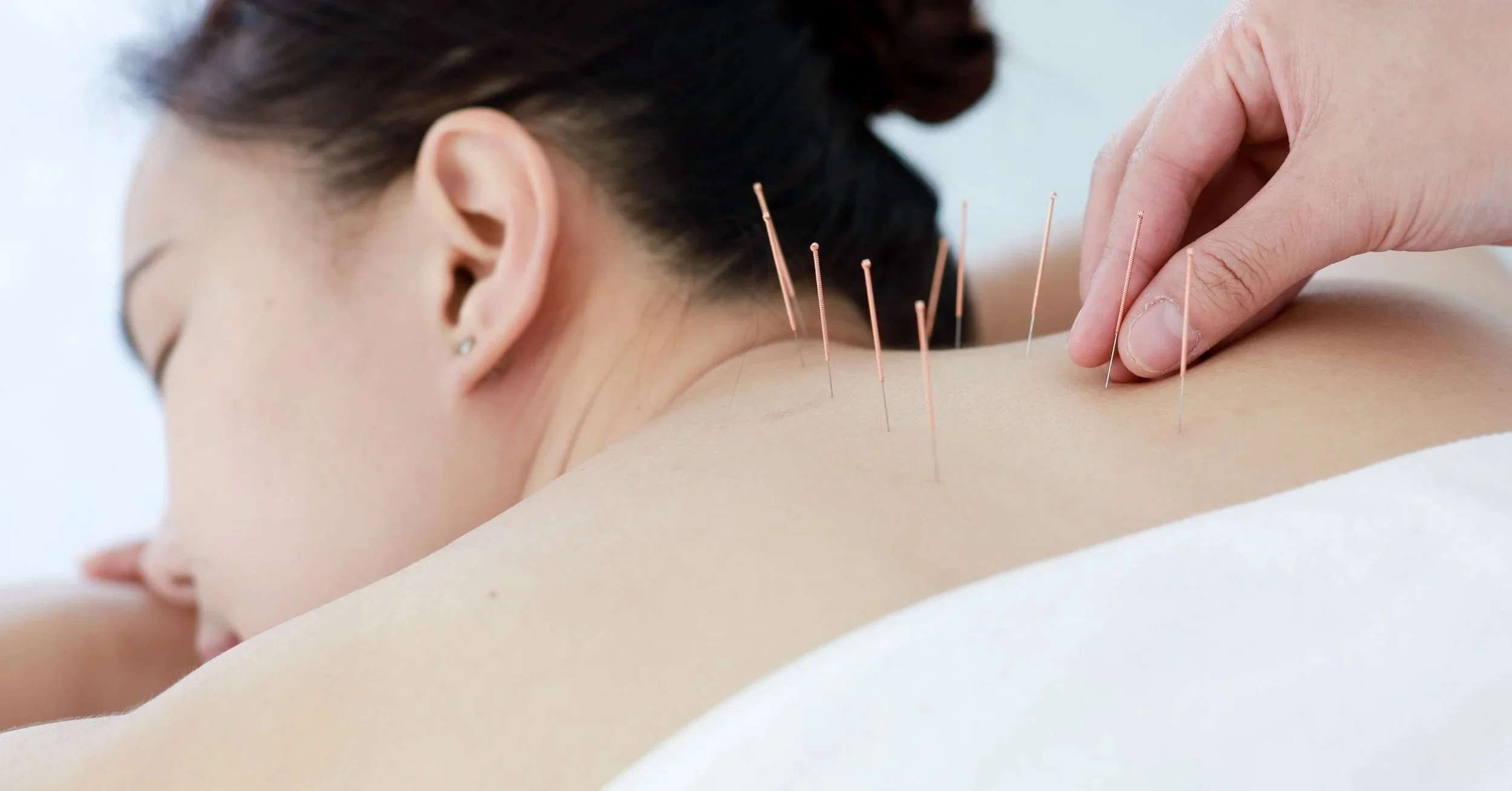 Upper back acupuncture for nerve relief