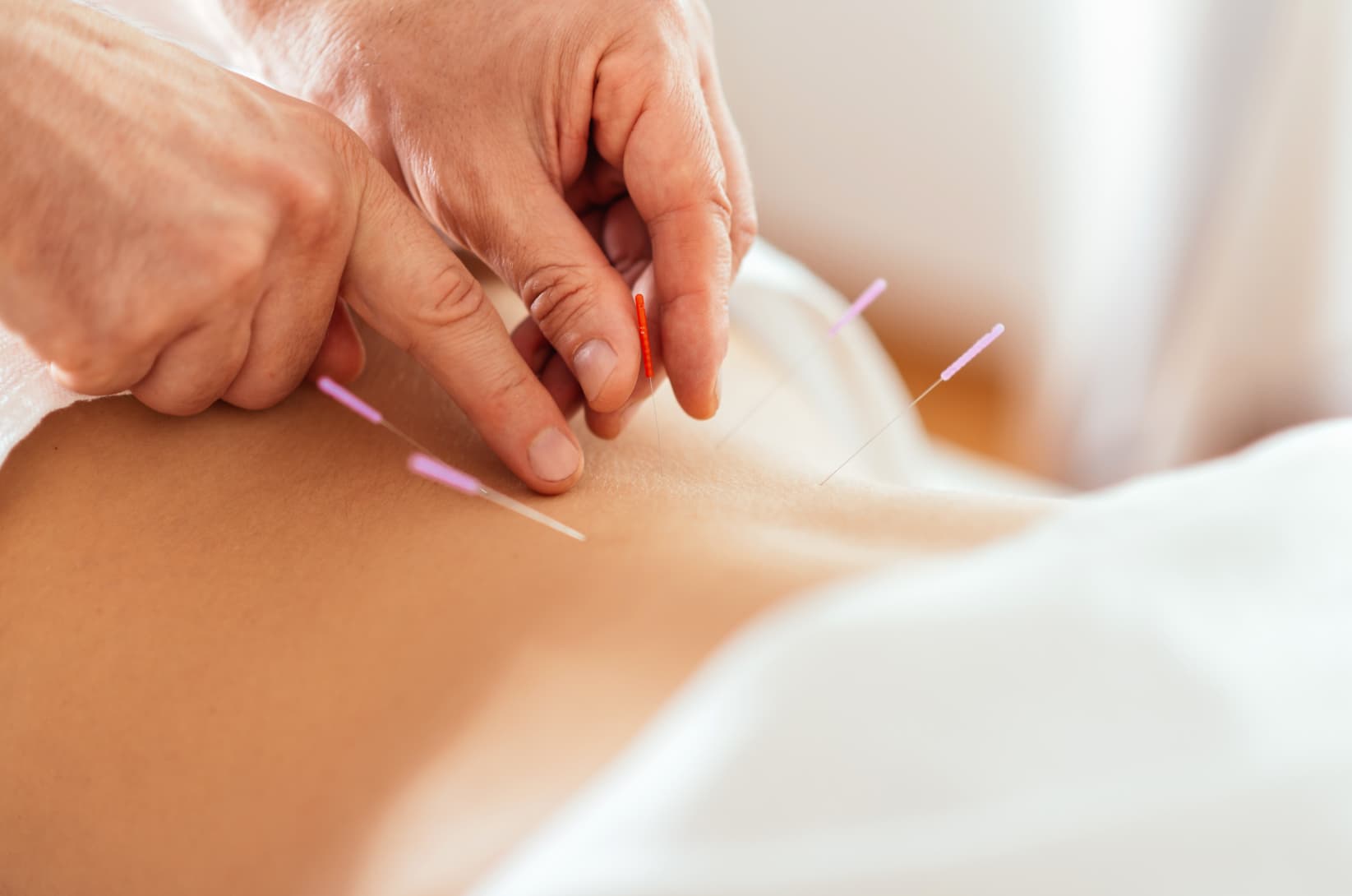 AcupunctureStockPics14