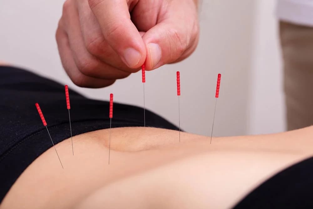 Stress Relief Acupuncture – How Acupuncture Eases Stress Naturally — Acupuncture Xperts, Boca Raton FL
