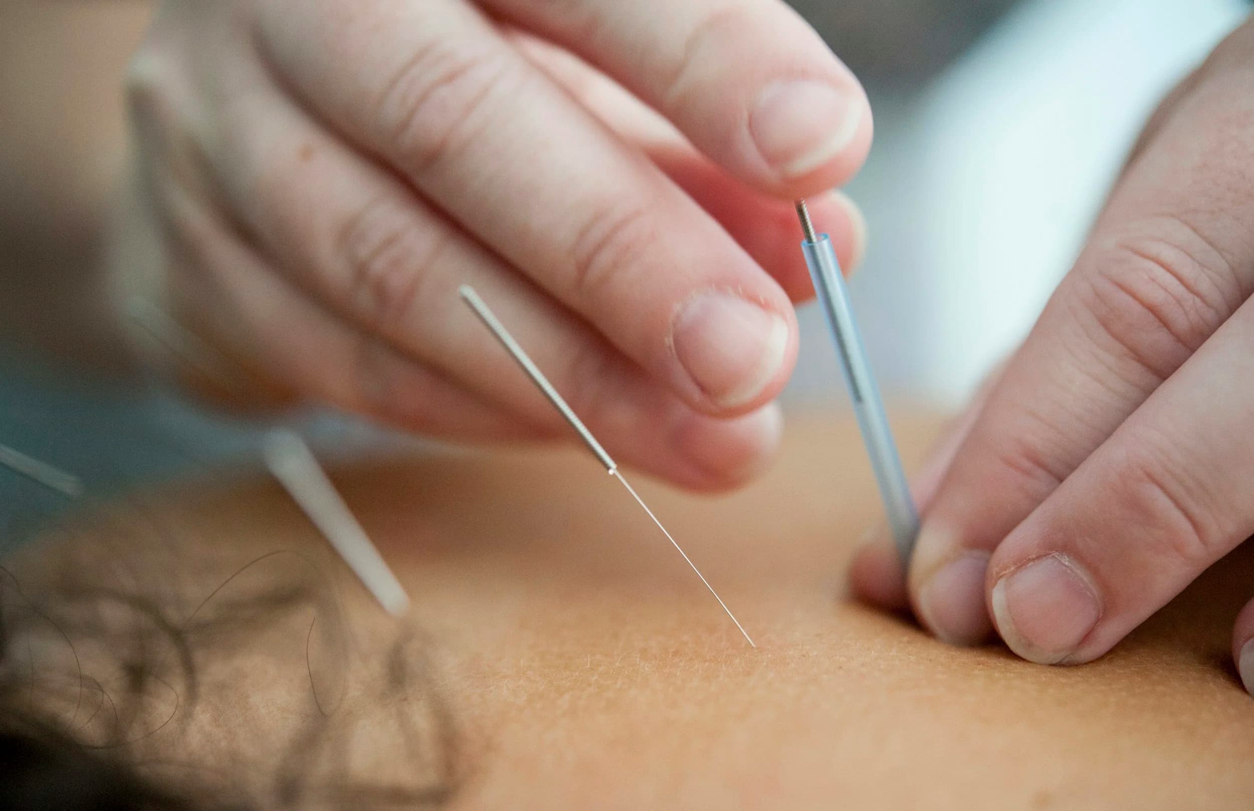 Why You Should Look into Acupuncture for Menopause and Weight Loss — Acupuncture Xperts, Boca Raton FL