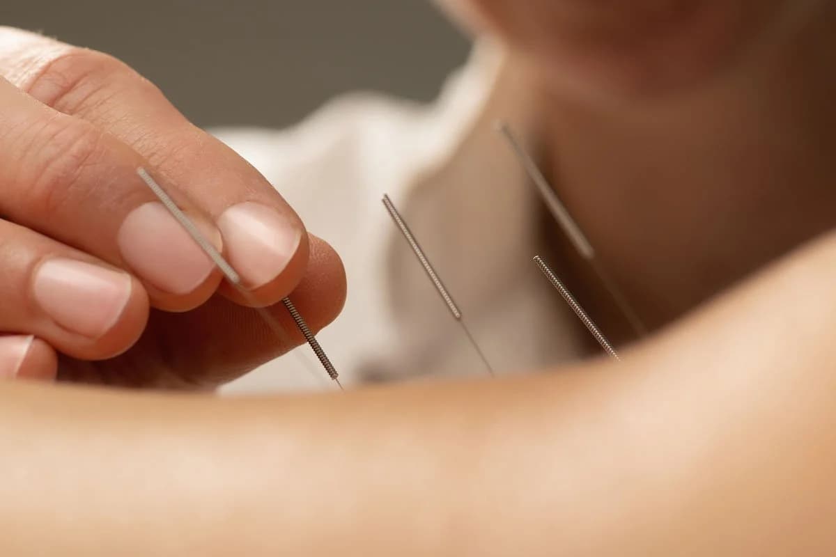 An acupuncturist treating a patient with neuropathy