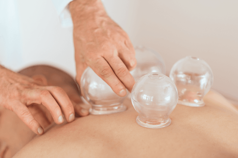 Cupping
