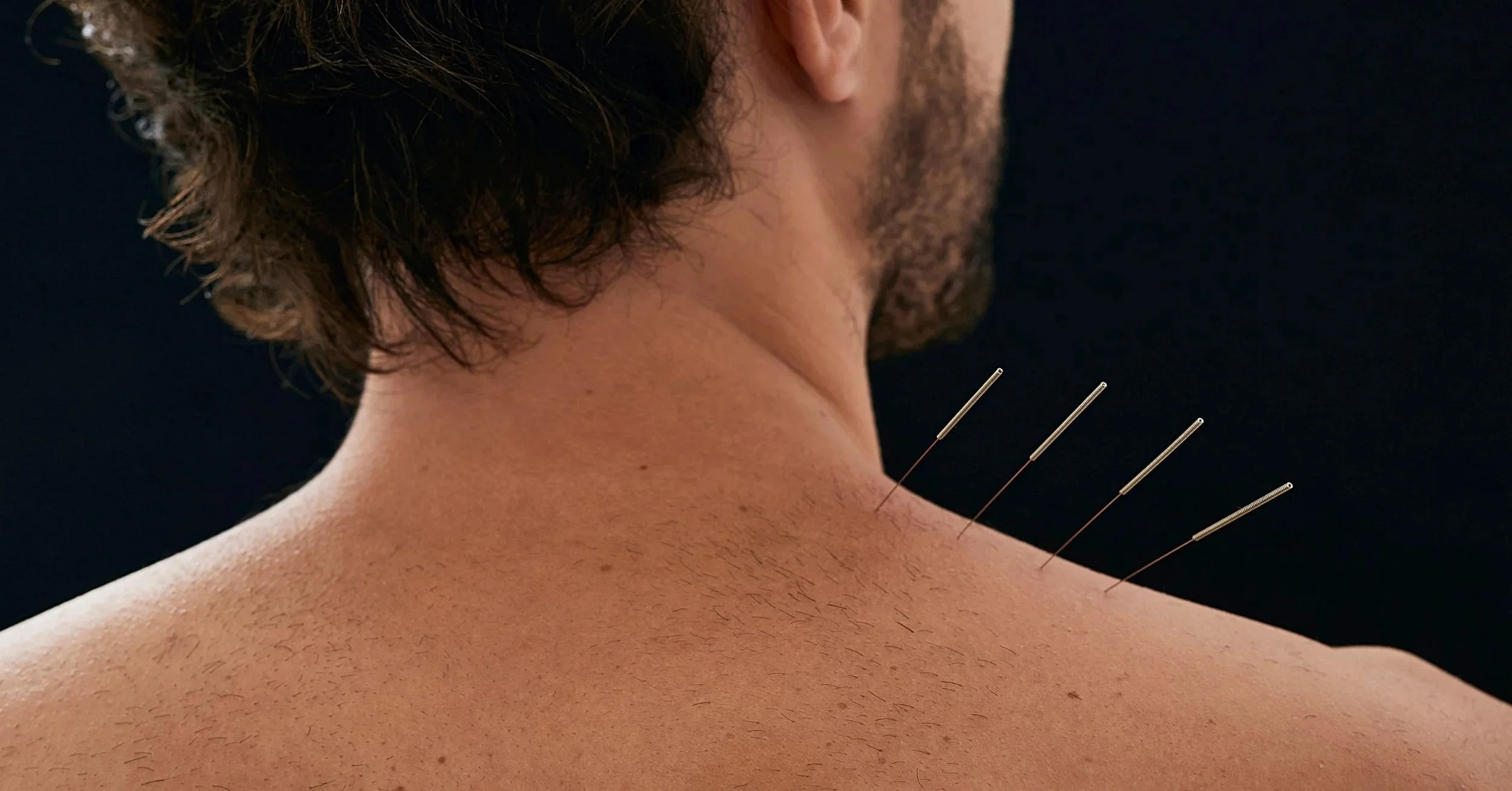 Acupuncture needles cervical spine pinched nerve