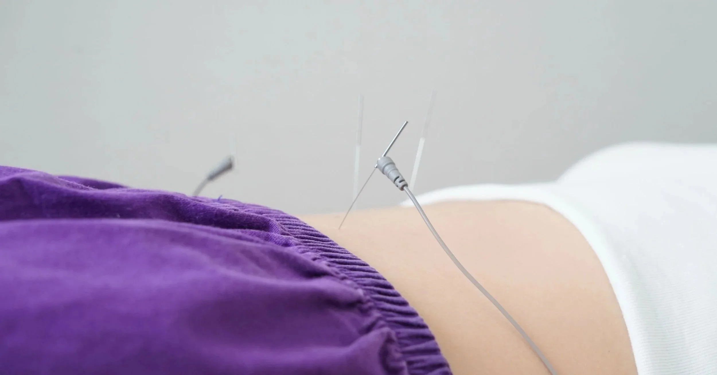 Electro acupuncture treatment nerve stimulation