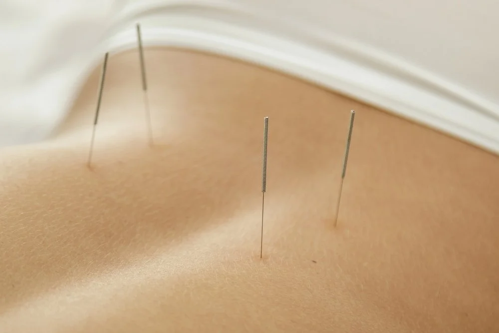 Can Acupuncture Help Relieve Menstrual Cramps? Here’s What You Need to Know! — Acupuncture Xperts, Boca Raton FL