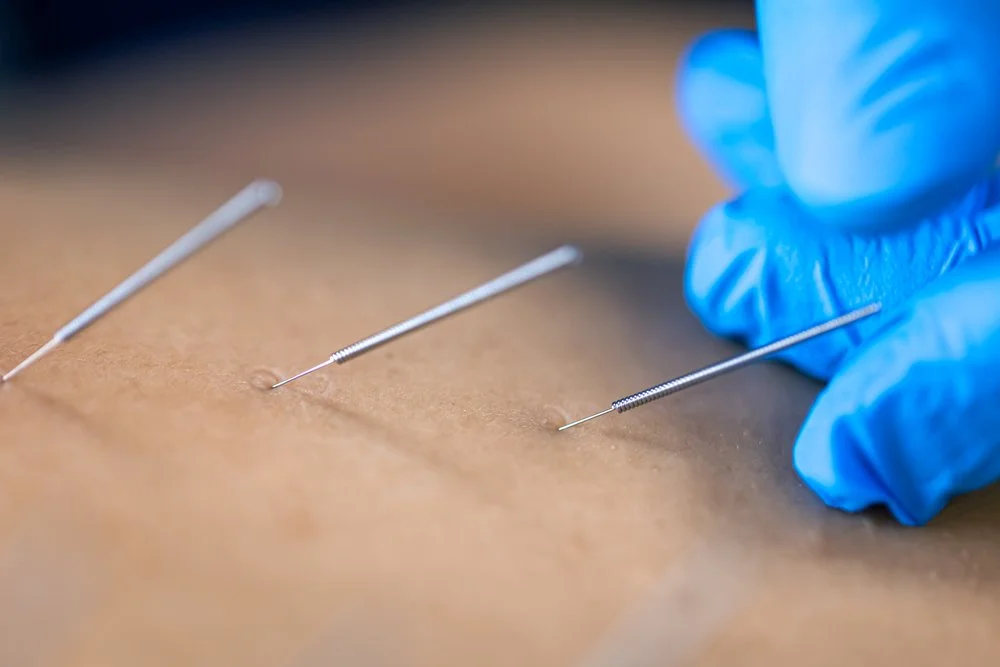 Compelling Benefits of Acupuncture for Lower Back Pain — Acupuncture Xperts, Boca Raton FL