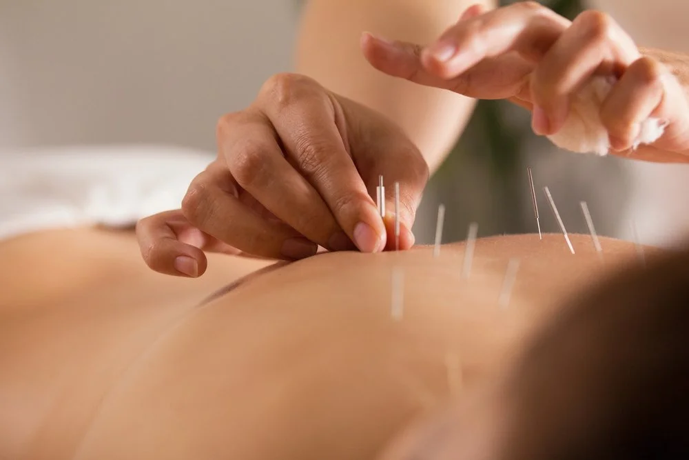 Dry needling vs. acupuncture