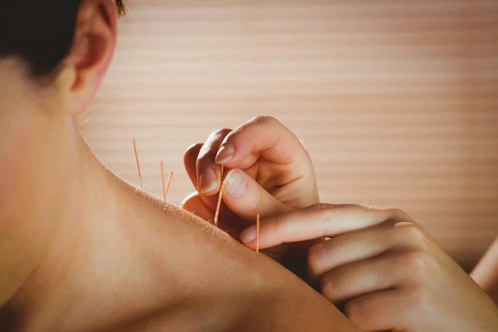 Dry needling vs. acupuncture