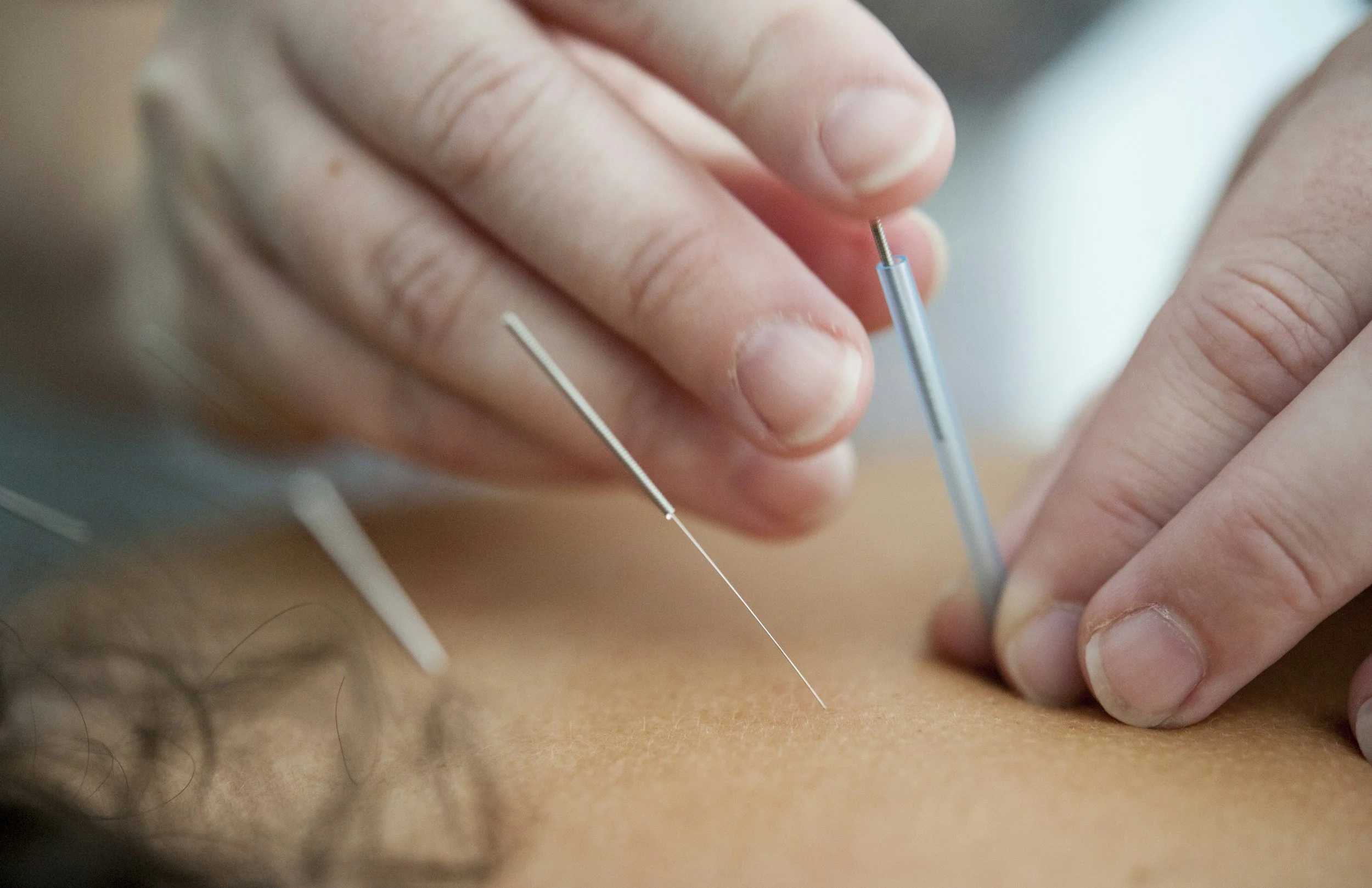 How to Find a Qualified Acupuncturist: Tips for Choosing the Right Practitioner — Acupuncture Xperts, Boca Raton FL