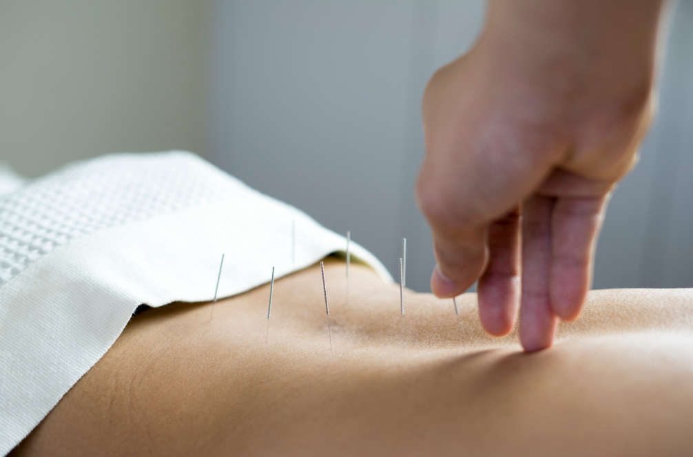 AcupunctureStockPics10
