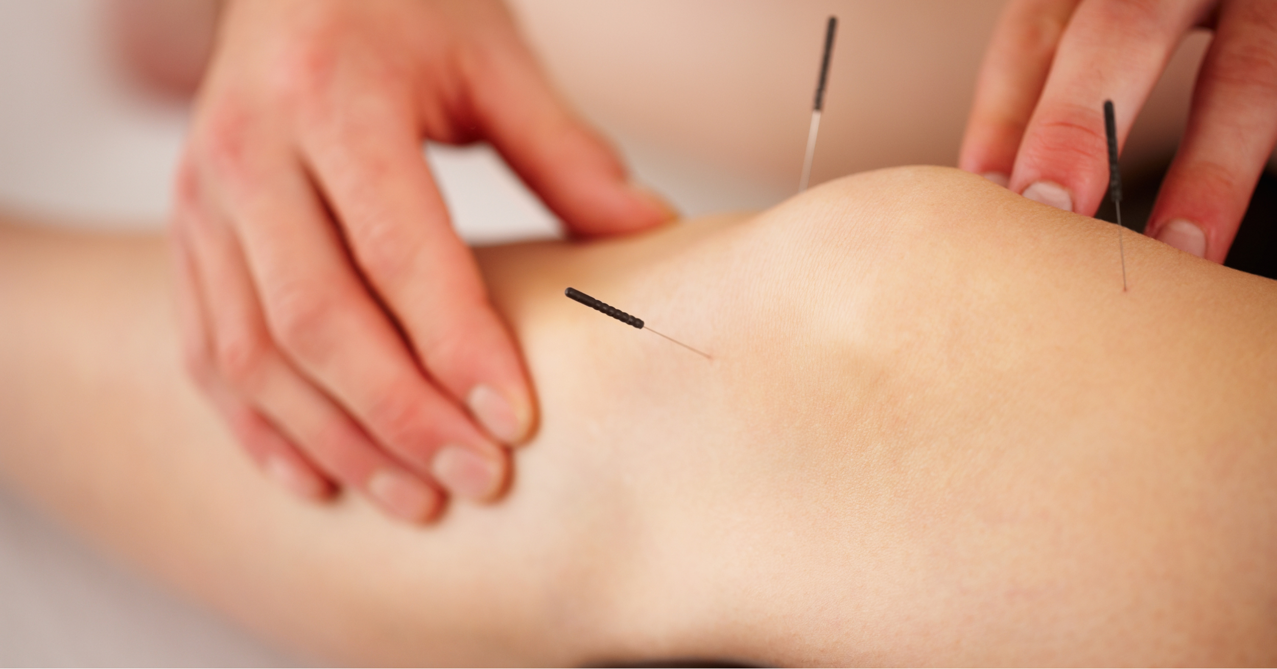 Acupuncture for knee pain joint rehabilitation