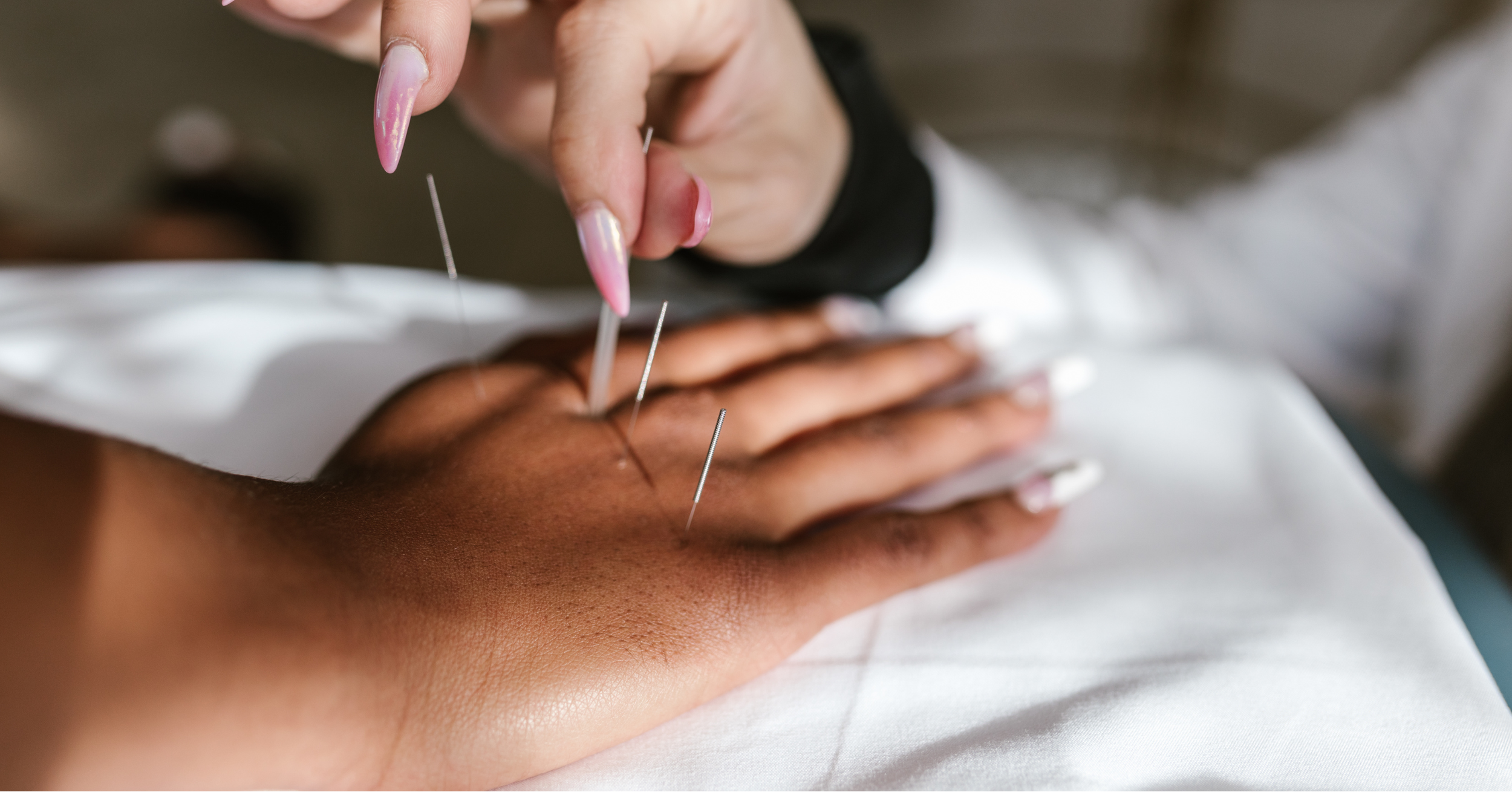 Acupuncture hand therapy neurological stimulation