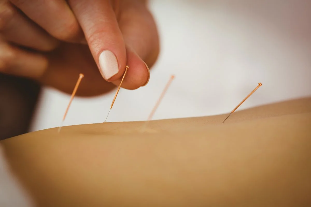 Young woman getting acupuncture for neuropathy